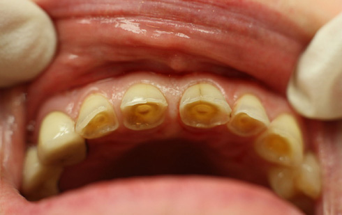 Стертость зубов