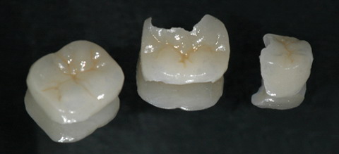 Керамические зубные пломбы