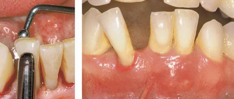 Степени подвижности зубов при пародонтите