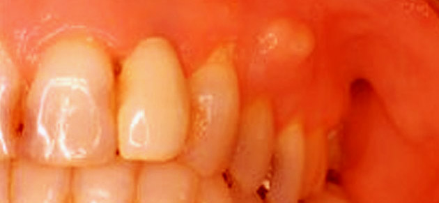 Пародонтальная киста зуба лечение